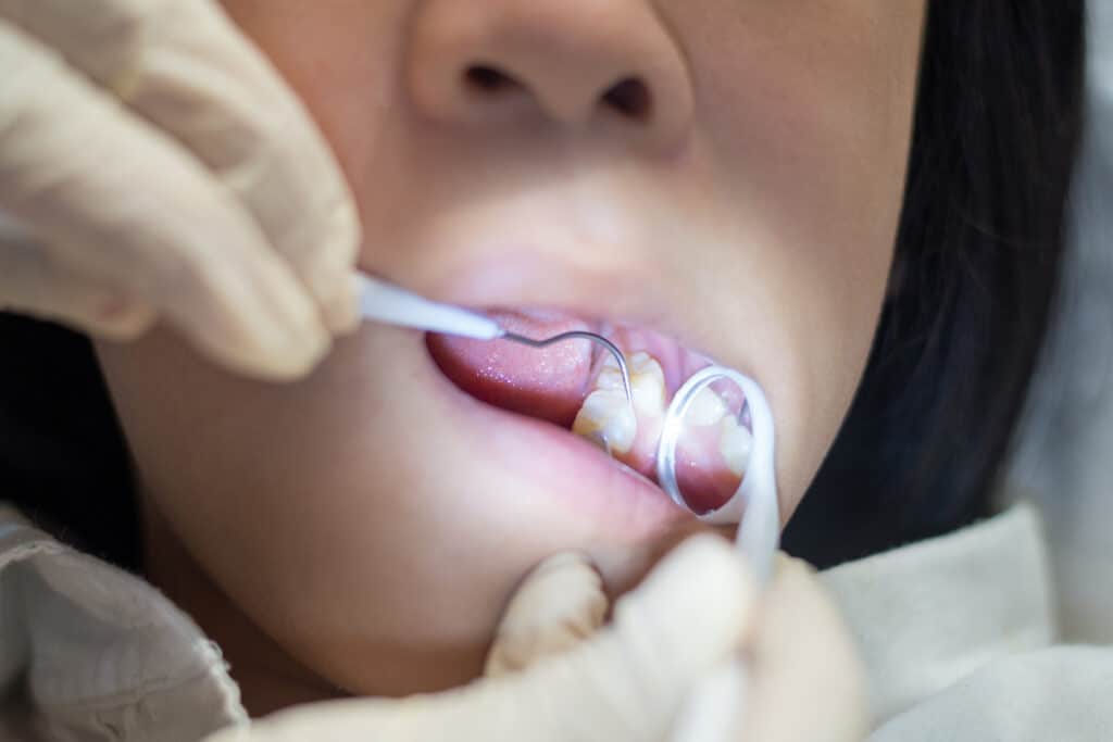 Child receiving a dental sealant