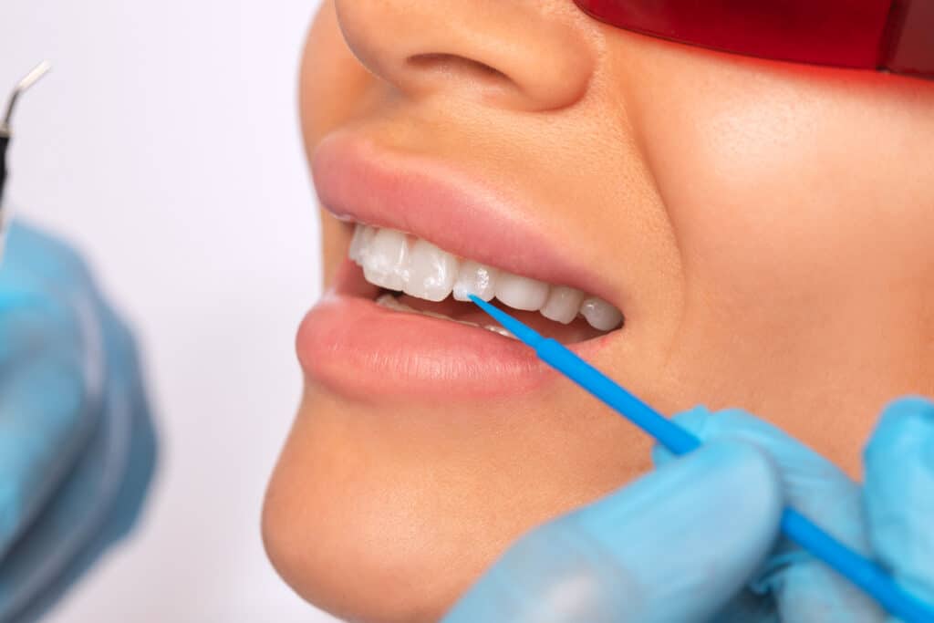 Dentist applying fluoride varnish to a patients teeth