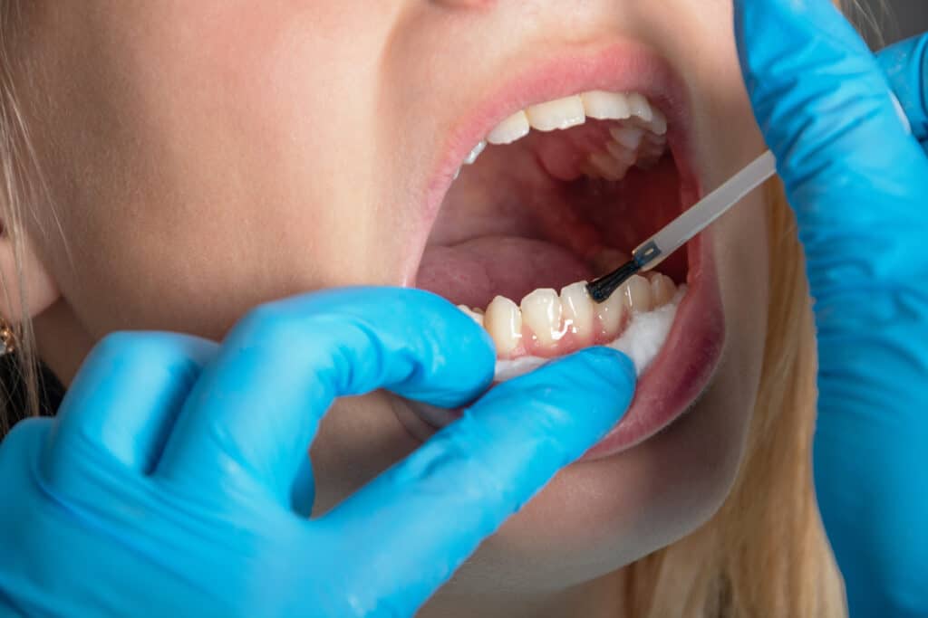 Patient receiving fluoride varnish