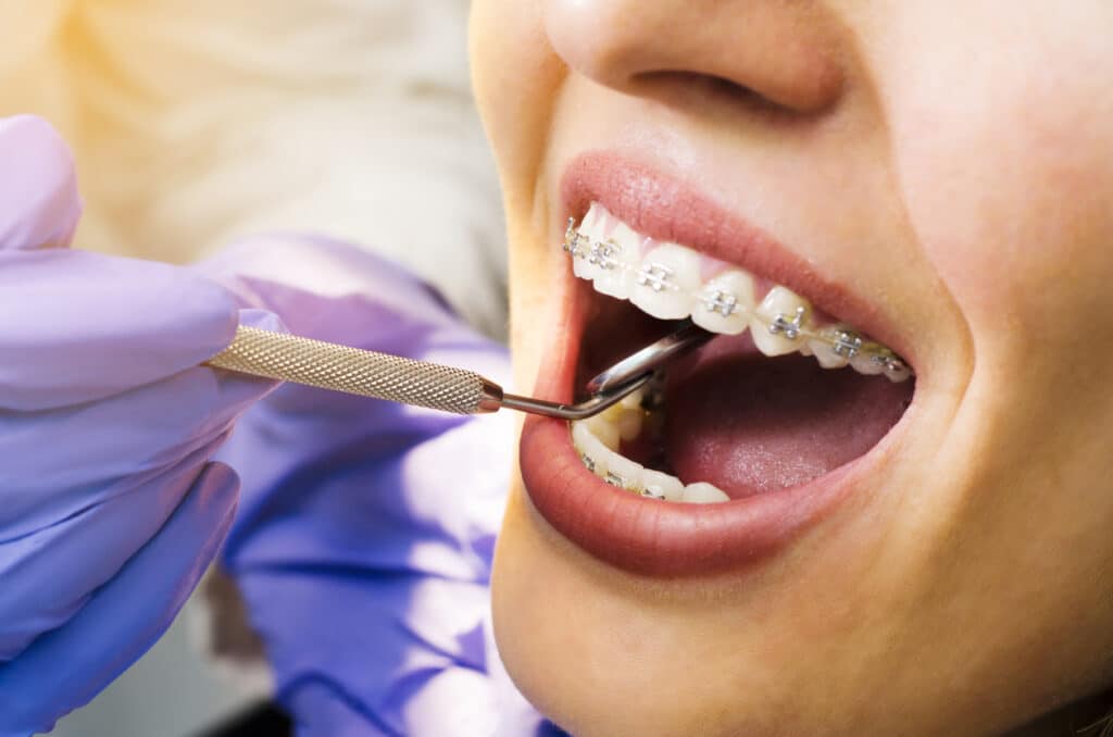 Dentist cleaning a patients braces