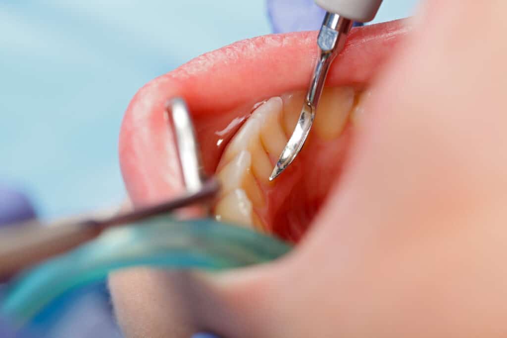 Dentist performing scaling of the teeth